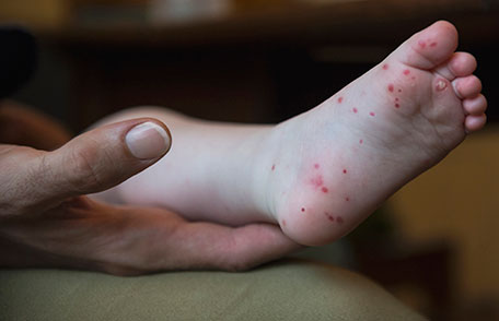 Hand, Foot, and Mouth Disease - From a Mommy Doc Perspective